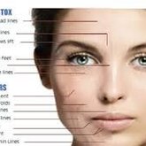 Botox Procedure explained